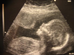 biometrie fetala si indicii biometriei fetale